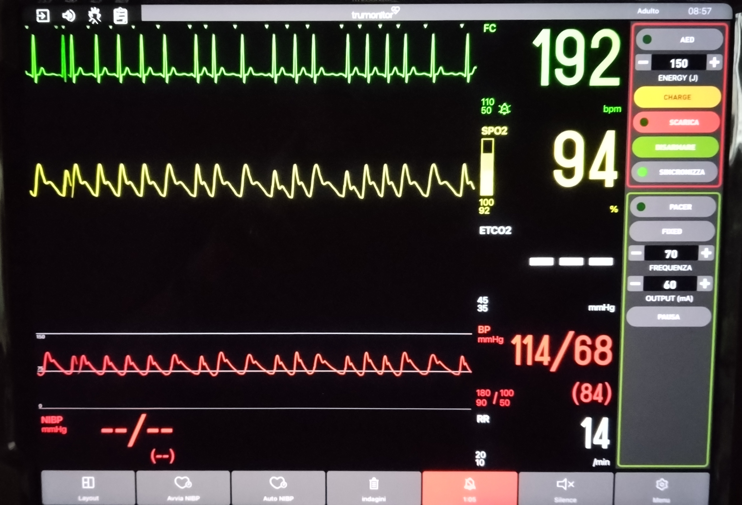 Cardioversione elettrica sincronizzata